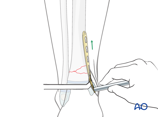 Plate insertion for minimally invasive plating of a metaphyseal fracture of the distal tibia