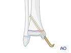 Open reduction and K-wire fixation of a Salter-Harris I fracture of the distal tibia 