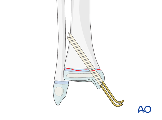 K-wire fixation of a Salter-Harris I fracture of the distal tibia