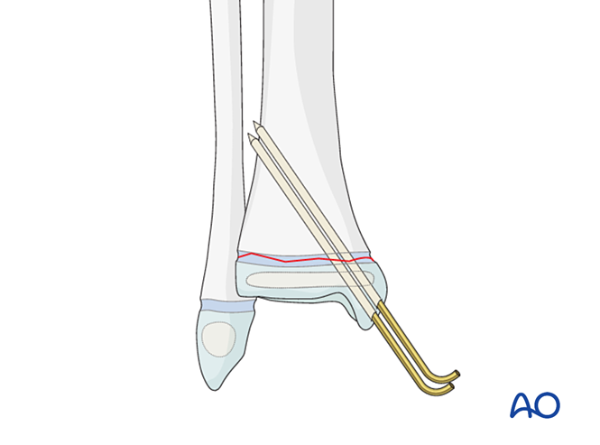 Open Reduction K Wire Fixation For Epiphysiolysis Salter Harris I Of