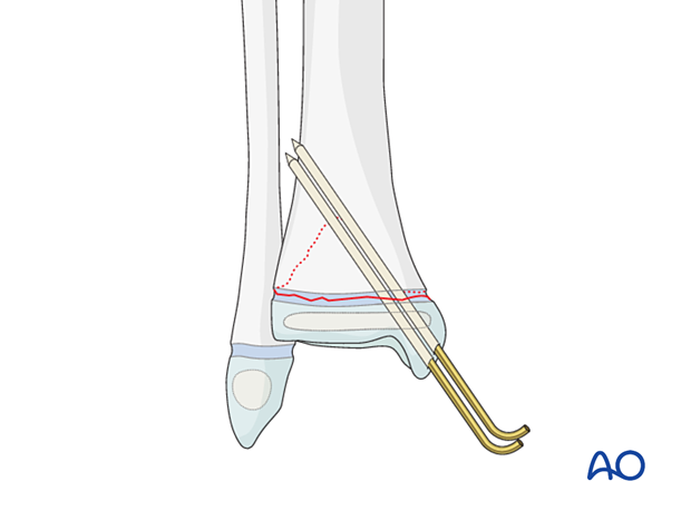 Open reduction and K-wire fixation of a Salter-Harris II fracture of the distal tibia