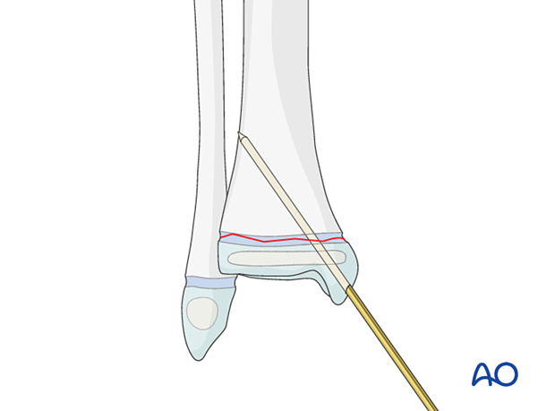 Insertion of first K-wire for fixation of a Salter-Harris I fracture of the distal tibia