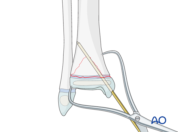 Insertion of first K-wire for fixation of a Salter-Harris II fracture of the distal tibia