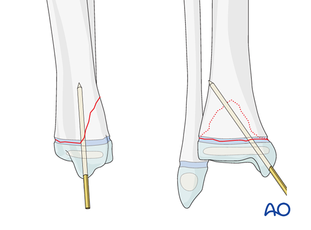 Insertion of K-wire for fixation of a Salter-Harris II fracture of the distal tibia