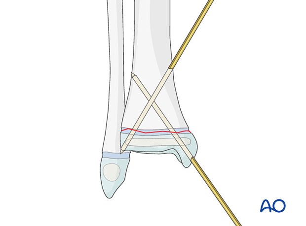 Insertion of second K-wire for fixation of a Salter-Harris I fracture of the distal tibia