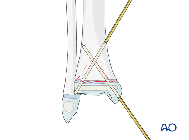 Insertion of second K-wire for fixation of a Salter-Harris II fracture of the distal tibia