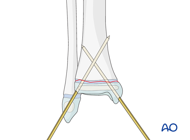 Insertion of second K-wire for fixation of a Salter-Harris I fracture of the distal tibia