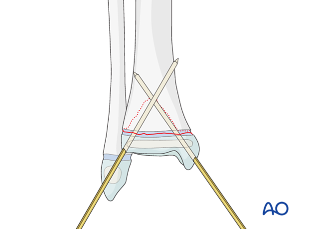 Insertion of second K-wire for fixation of a Salter-Harris II fracture of the distal tibia