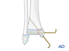 Open reduction and K-wire fixation of a Salter-Harris III fracture of the distal tibia 