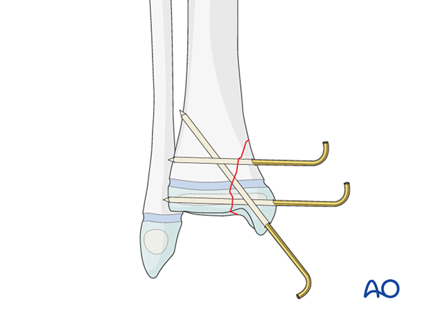 Open reduction and K-wire fixation of a simple Salter-Harris IV fracture of the distal tibia