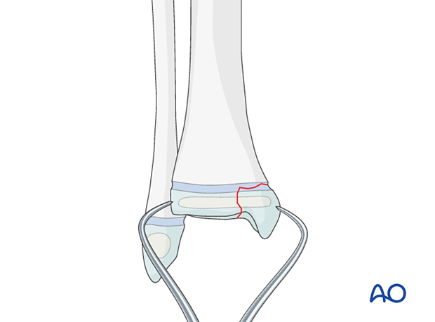 Open reduction of a Salter-Harris III fracture of the distal tibia