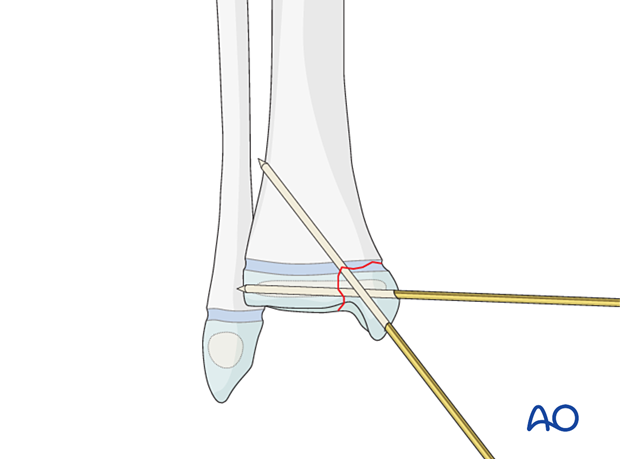 K-wire fixation of a Salter-Harris III fracture of the distal tibia