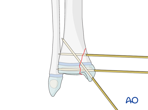 K-wire fixation of a simple Salter-Harris IV fracture of the distal tibia