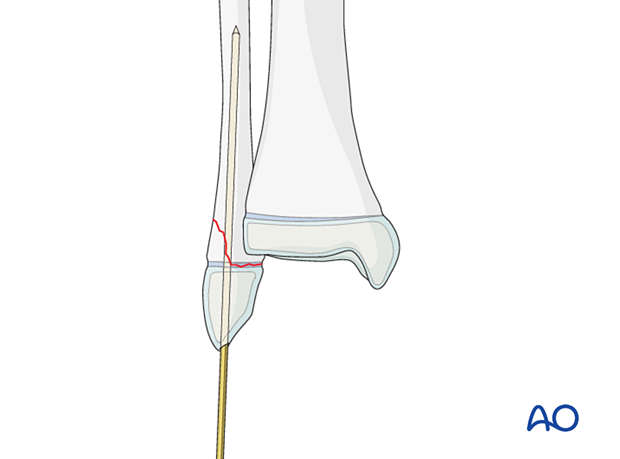 Insertion of a K-wire for fixation of a Salter-Harris II fracture of the distal fibula