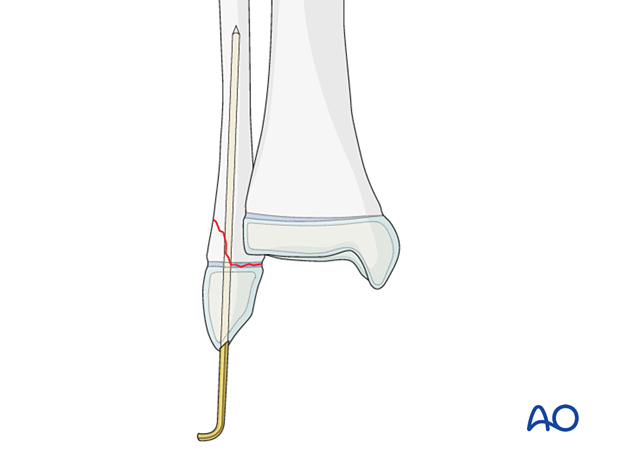 Open reduction and K-wire fixation of a Salter-Harris II fracture of the distal fibula