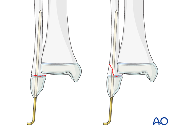 Open reduction and K-wire fixation of a Salter-Harris I and II fracture of the distal fibula