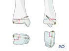 Open reduction and screw fixation of a Tillaux fracture 