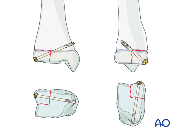 Open reduction and screw fixation of a Tillaux fracture