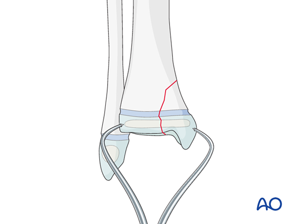 Open reduction of a Salter-Harris IV fracture of the distal tibia