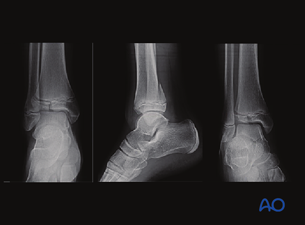AP, lateral, and mortise x-rays of a triplane fracture