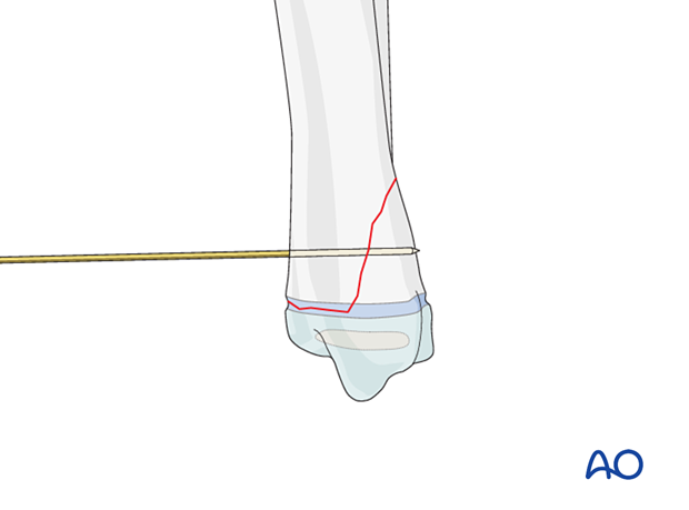 Insertion of a guide wire for screw fixation of a Salter-Harris II fracture of the distal tibia