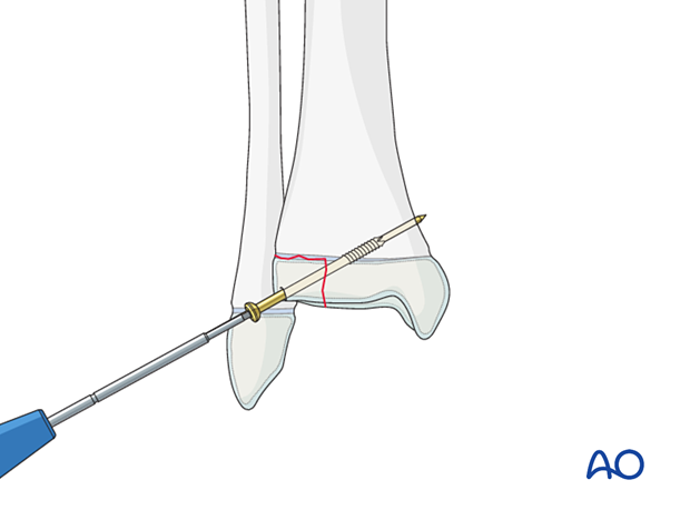 Screw fixation of a Tillaux fracture
