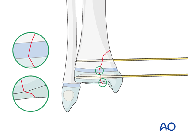 Instertion of the guide wires for screw fixation of a Salter-Harris IV fracture of the distal tibia