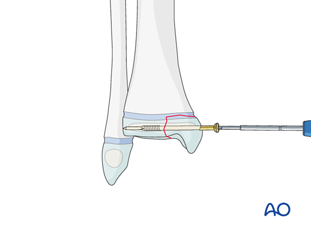 Screw fixation of a Salter-Harris III fracture of the distal tibia
