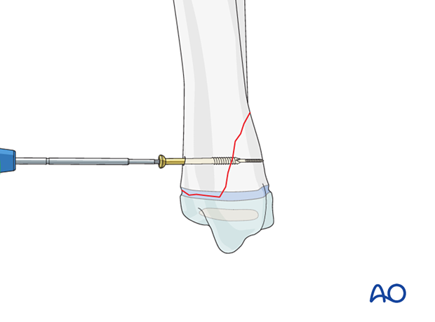 Screw fixation of a Salter-Harris II fracture of the distal tibia