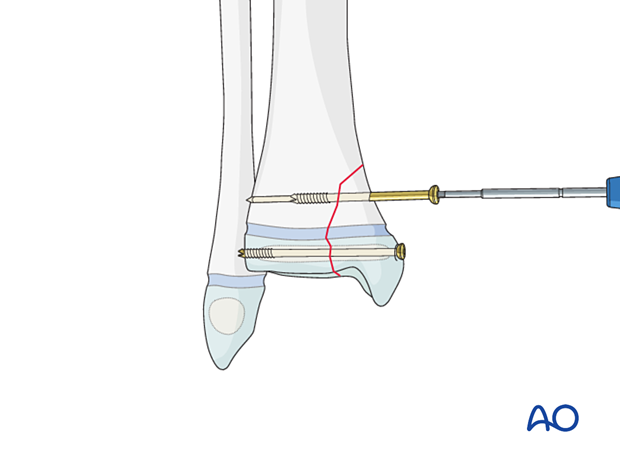 Screw fixation of a Salter-Harris IV fracture of the distal tibia