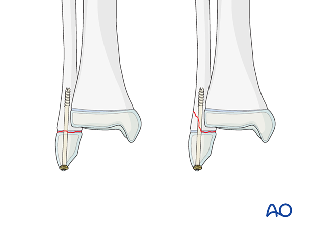 Open reduction and screw fixation of a Salter-Harris I and II fracture of the distal fibula