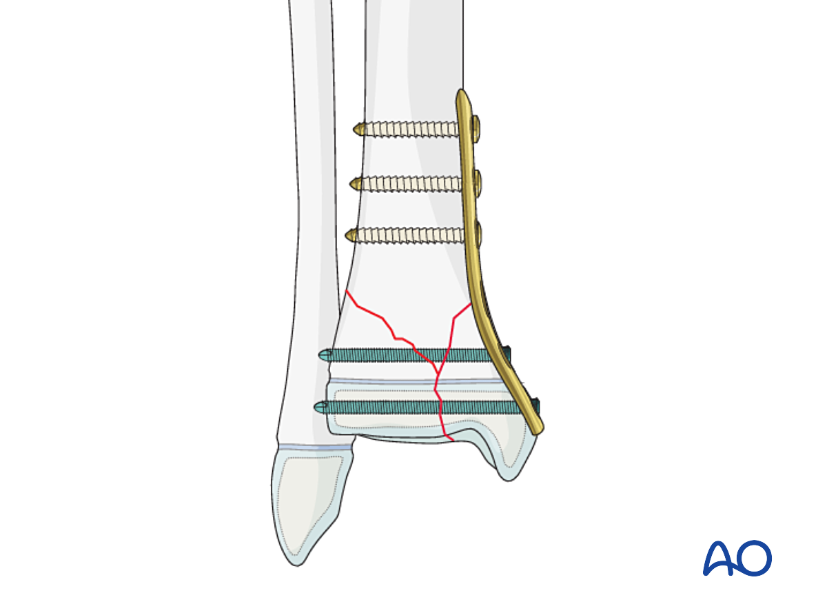 Open Reduction; Plate Fixation For Epi-/metaphyseal Fractures (Salter ...