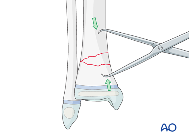 Open reduction with reduction forceps of a metaphyseal distal tibial fracture