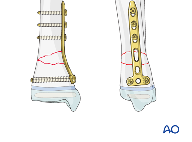 Open reduction and plate fixation of a metaphyseal distal tibial fracture