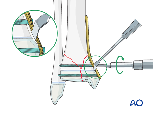 An elevator may be used to protect the perichondral ring during plating of a multifragmentary distal tibial Salter-Harris IV fracture