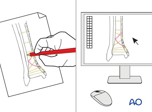 Preoperative planning for plate fixation of a metaphyseal fracture of the distal tibia