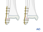 Plate fixation of a Salter-Harris I and II fracture of the distal fibula