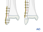 Plate fixation of a metaphyseal distal fibular fracture