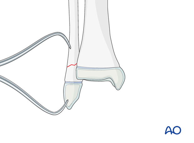 Reduction of a metaphyseal distal fibular fracture stabilized with reduction forceps
