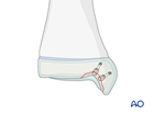 Screw fixation of a flake fracture of the distal tibia