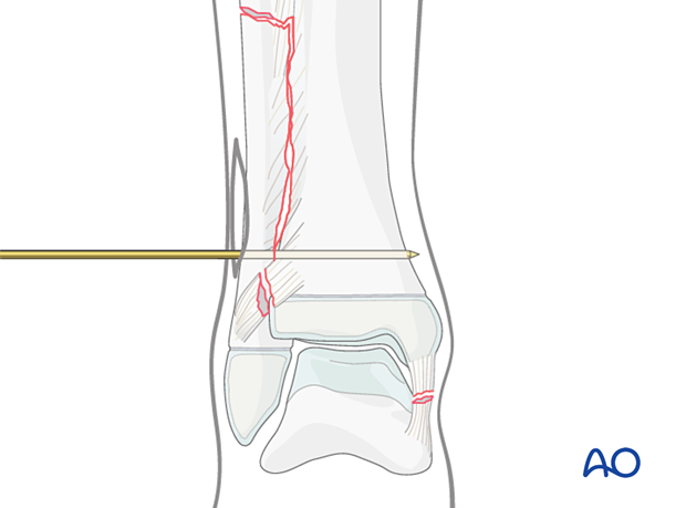 Preliminary K-wire stabilization of a reduced syndesmotic injury