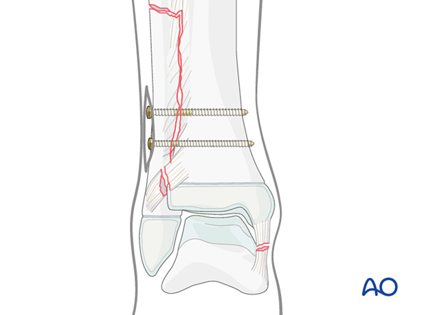 Syndesmotic transfixation with screws