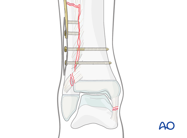 Syndesmotic transfixation with screws and plating of a diaphyseal fibular fracture