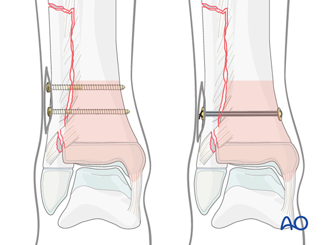 Syndesmotic stabilization