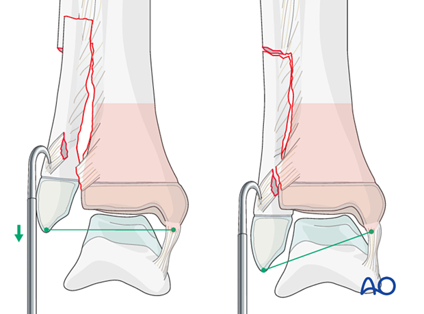 Reduction of the fibula in a syndesmotic injury