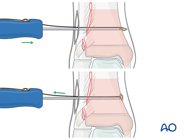 Insertion of suture and button for fixation of a syndesmotic injury