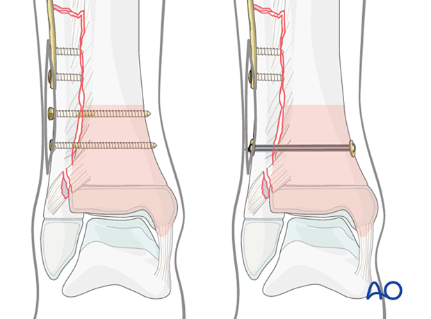 Syndesmotic transfixation and plating of a diaphyseal fibular fracture