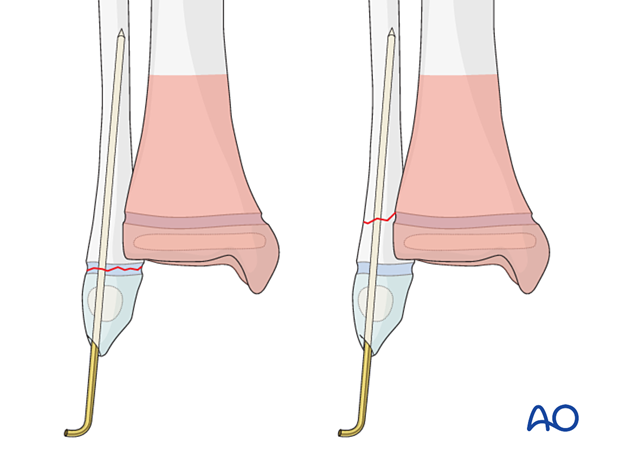 K-wire fixation of an associated distal fibular fracture