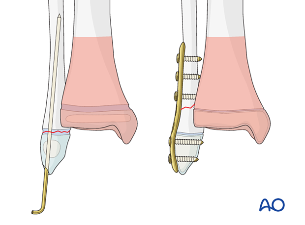 K-wire and plate fixation of an associated distal fibular fracture