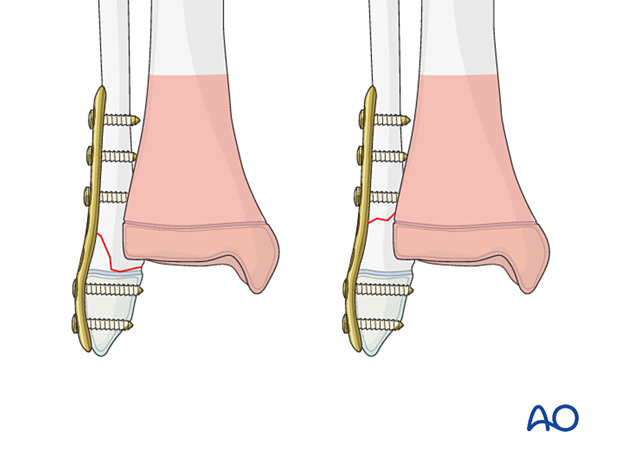 Plate fixation of an associated distal fibular fracture